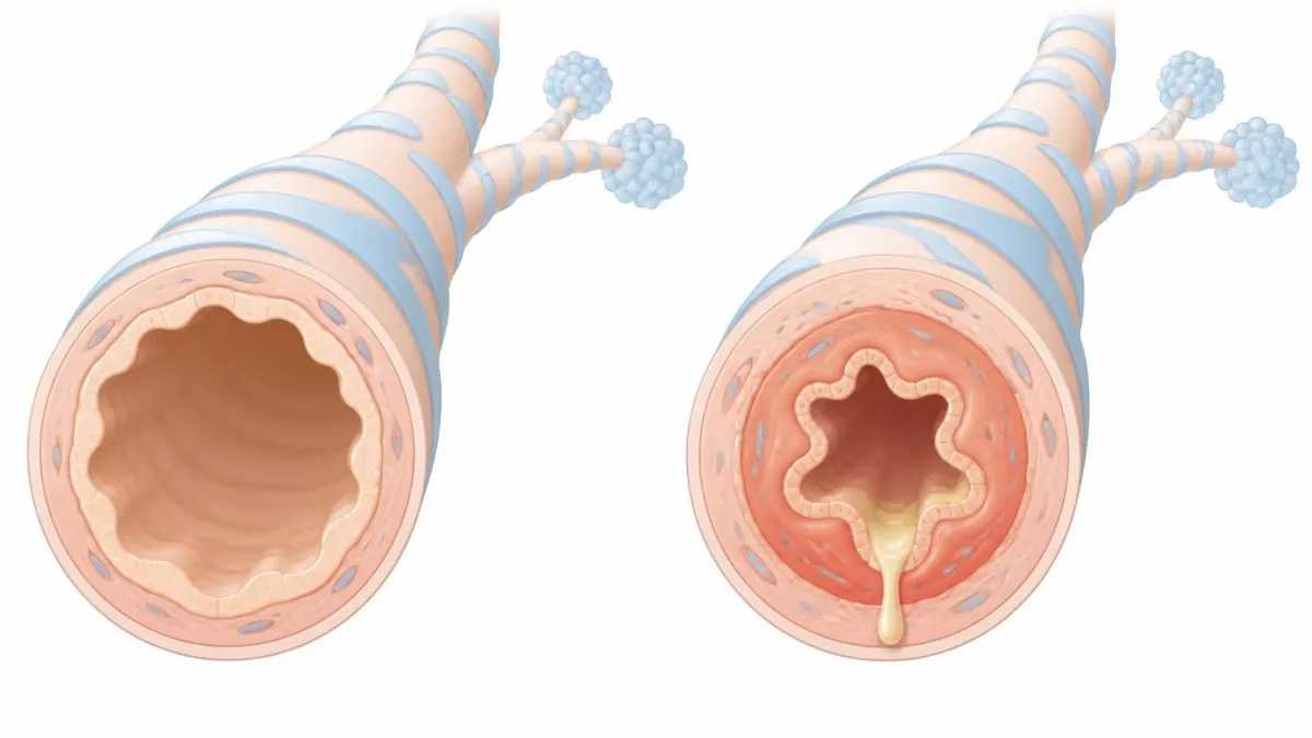 Illustratie van vernauwde luchtwegen bij astma op de ervaringspagina van HaloClinic Nederland