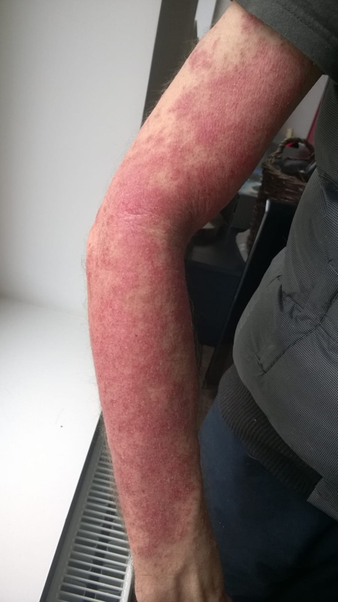 Foto von Jan – Haut vor und während der Halotherapie bei Ekzem