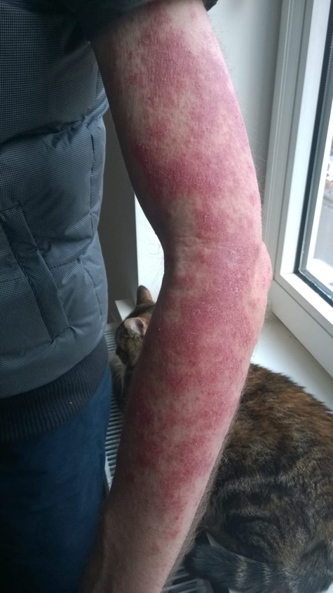 Foto von Jan – Haut vor und während der Halotherapie bei Ekzem