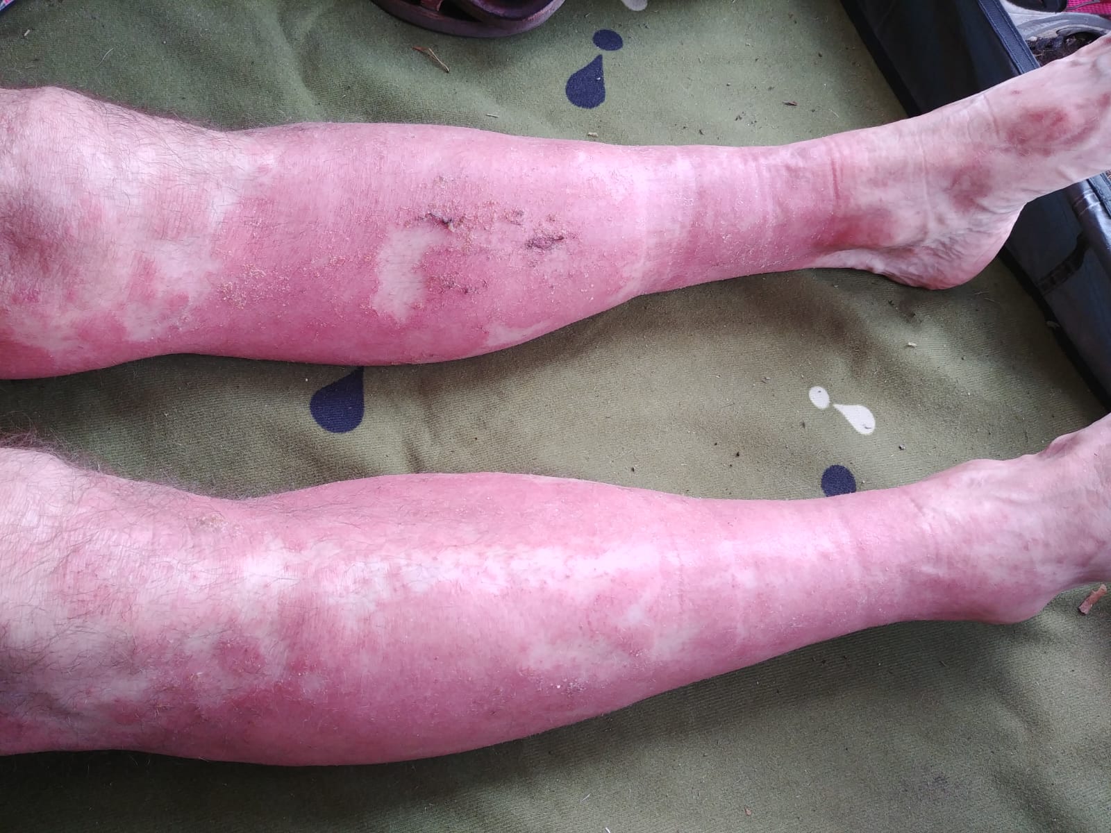 Foto von Jan – Haut vor und während der Halotherapie bei Ekzem