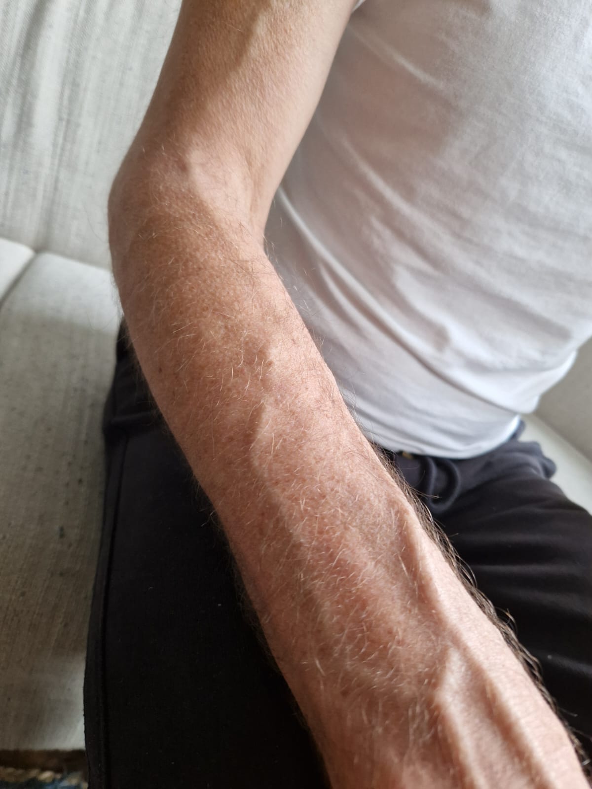 Foto von Jan – Haut vor und während der Halotherapie bei Ekzem