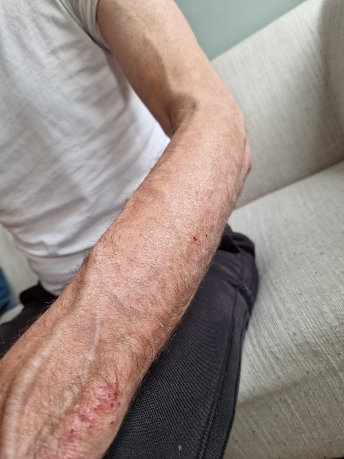 Foto von Jan – Haut vor und während der Halotherapie bei Ekzem