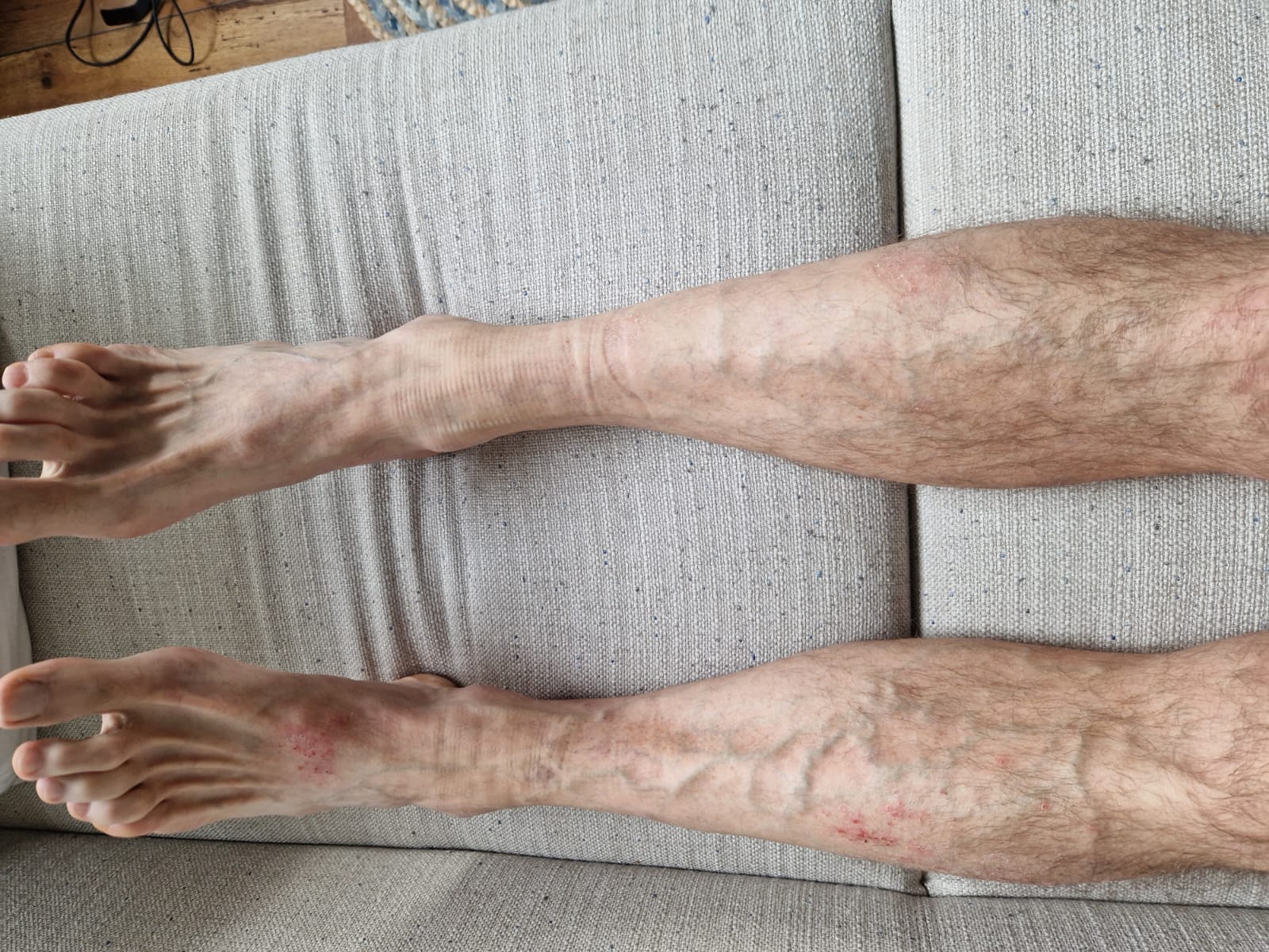 Foto von Jan – Haut vor und während der Halotherapie bei Ekzem