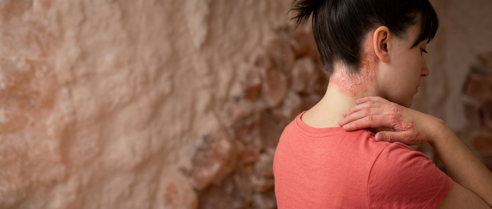 Vrouw met zichtbare psoriasis op haar arm ontspant in de zoutkamer van HaloClinic Nederland